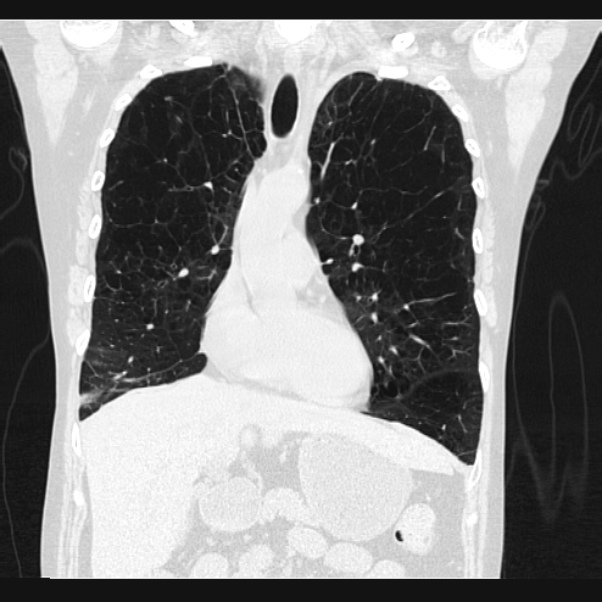 Centrilobular pulmonary emphysema (Radiopaedia 24495-24789 Coronal lung window 27).jpg