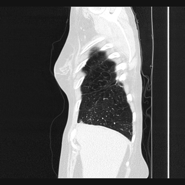 Centrilobular pulmonary emphysema (Radiopaedia 24495-24789 Sagittal lung window 9).jpg