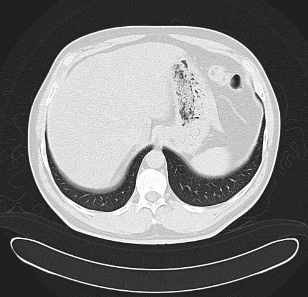 Centrilobular pulmonary emphysema (Radiopaedia 26808-26971 C 40).jpg