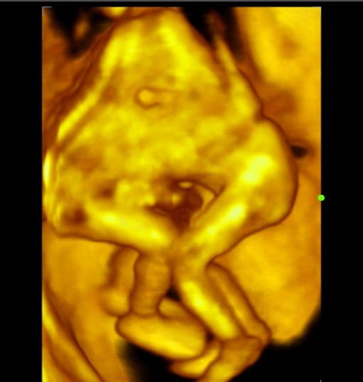 File:Cephalopagus conjoined twin (4D ultrasound) (Radiopaedia 84793-100256 D 1).jpg