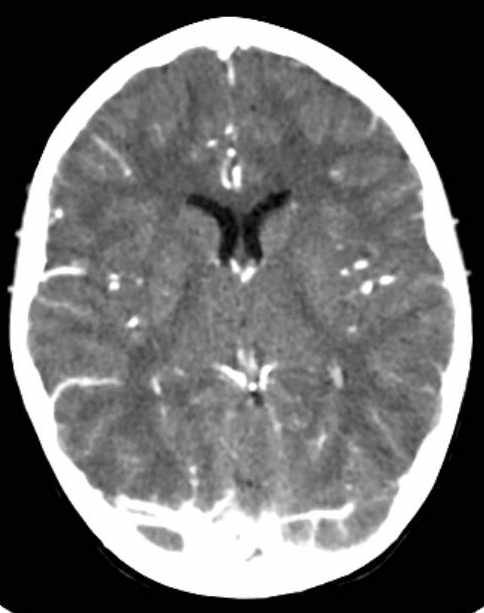 Cerebellar abscess (Radiopaedia 73727-84527 Axial C+ 43).jpg