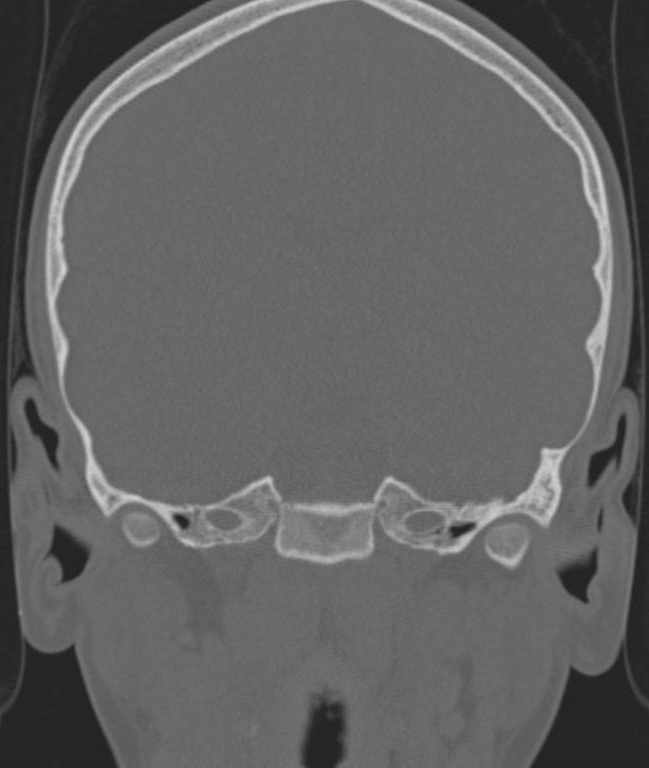 Cerebellar abscess (Radiopaedia 73727-84527 Coronal bone window 84).jpg