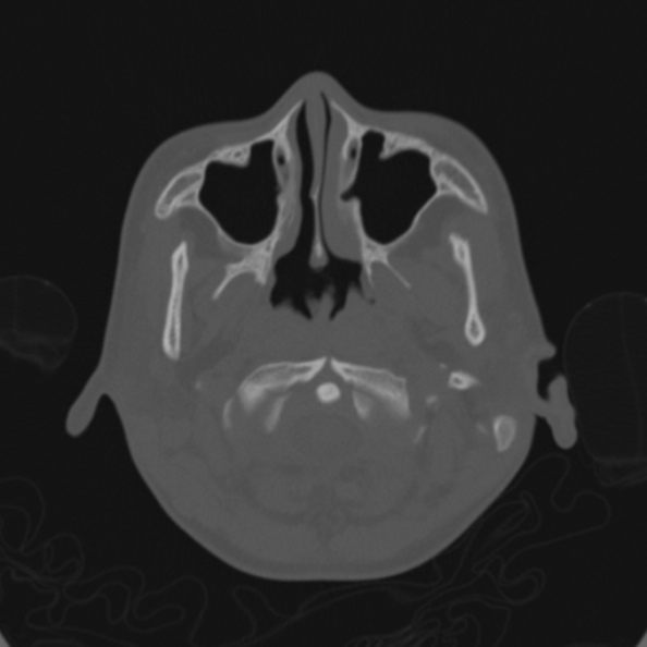 Cerebellar abscess secondary to mastoiditis (Radiopaedia 26284-26413 Axial bone window 11).jpg