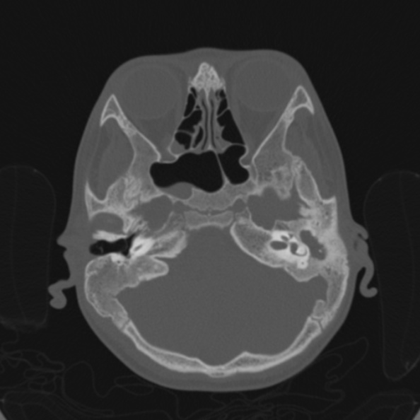 File:Cerebellar abscess secondary to mastoiditis (Radiopaedia 26284-26413 Axial bone window 49).jpg