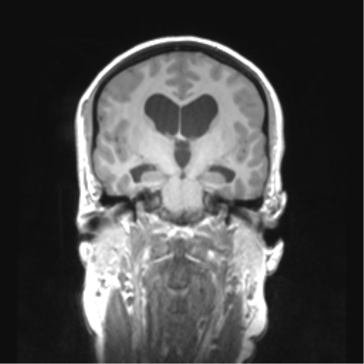 Cerebellar ependymoma complicated by post-operative subdural hematoma (Radiopaedia 83322-97736 Coronal T1 27).png