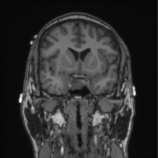Cerebellar hemangioblastomas and pituitary adenoma (Radiopaedia 85490-101176 Coronal T1 58).png