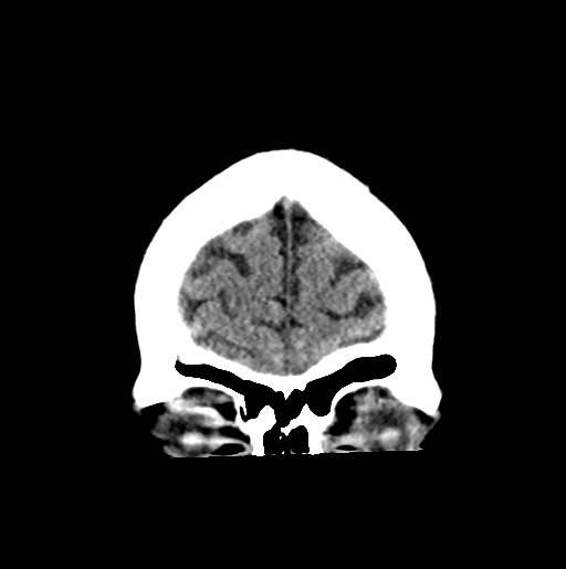 File:Cerebellar infarct due to vertebral artery dissection with posterior fossa decompression (Radiopaedia 82779-97030 Coronal non-contrast 7).png