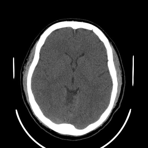 File:Cerebellar infarction (Radiopaedia 16625-16327 Axial non-contrast 19).jpg