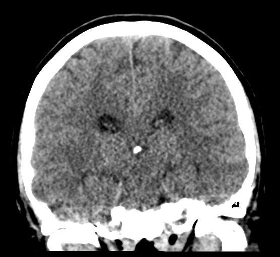 Cerebellar metastases - colorectal adenocarcinoma (Radiopaedia 40947-43652 Coronal non-contrast 55).png