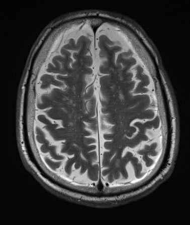 File:Cerebellar metastasis (Radiopaedia 33616-34718 Axial T2 30).png