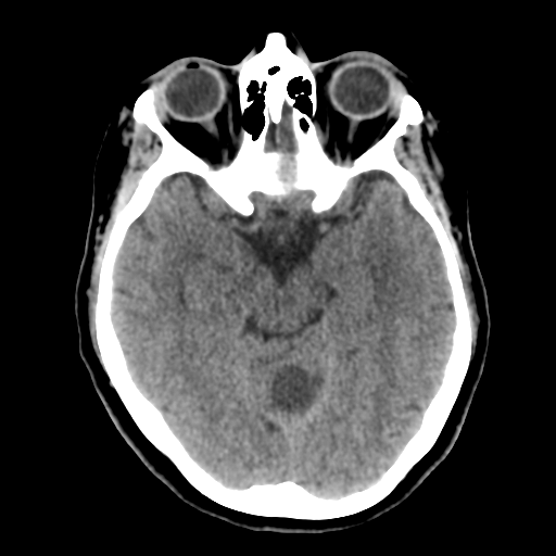 Cerebellar metastasis (cystic appearance) (Radiopaedia 41395-44258 Axial non-contrast 22).png