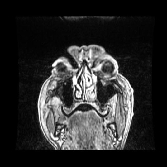 Cerebellar metastasis of pulmonary adenocarcinoma, cavernous venous malformation, and developmental venous anomaly (Radiopaedia 85827-101661 Coronal T1 C+ 90).jpg