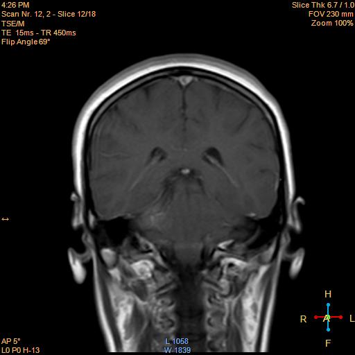 File:Cerebellopontine angle meningioma (Radiopaedia 22488-22525 Coronal T1 C+ 12).jpg