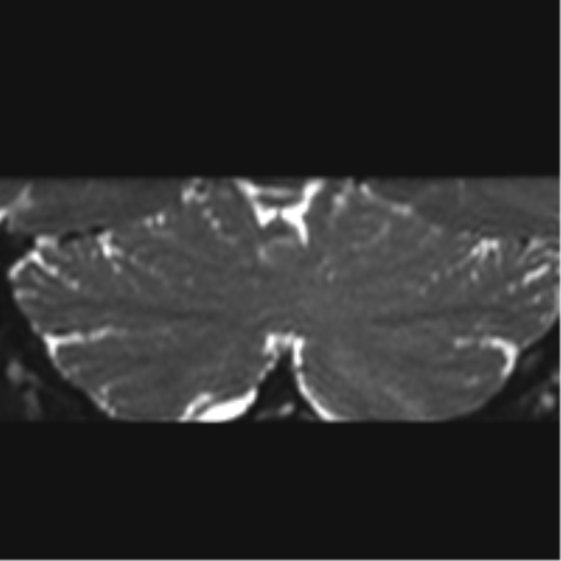 Cerebellopontine angle meningioma (Radiopaedia 48434-53348 Coronal T2 6).png