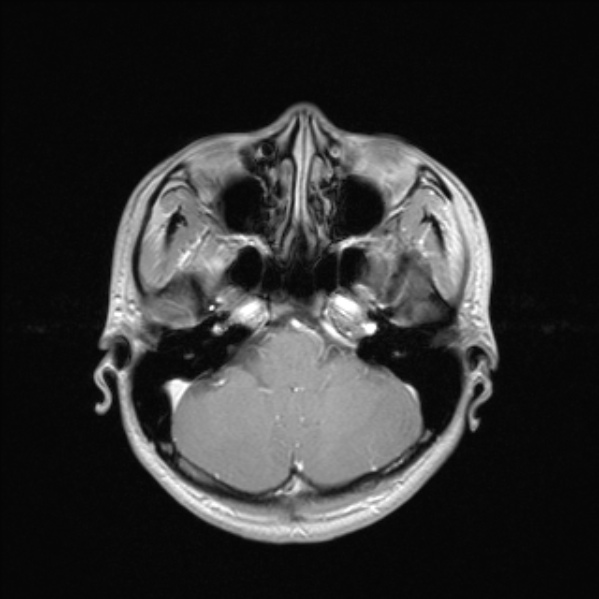 Cerebral abscess (Radiopaedia 24212-24478 Axial T1 C+ 18).jpg
