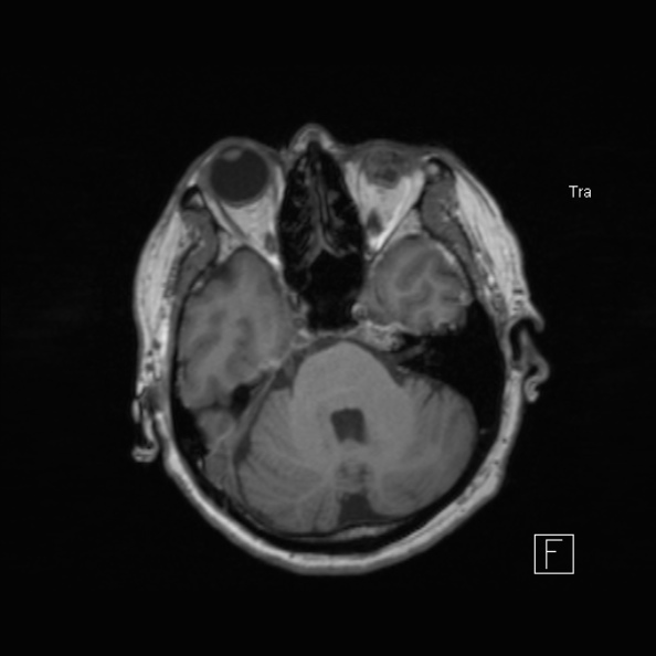 Cerebral abscess (Radiopaedia 26111-26247 Axial T1 22).jpg