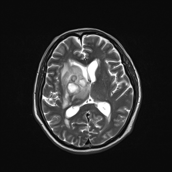 Cerebral abscess (Radiopaedia 26111-26247 Axial T2 35).jpg