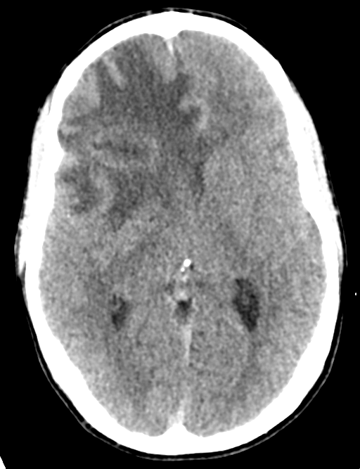 Cerebral abscess (Radiopaedia 60342-68008 Axial non-contrast 26).png