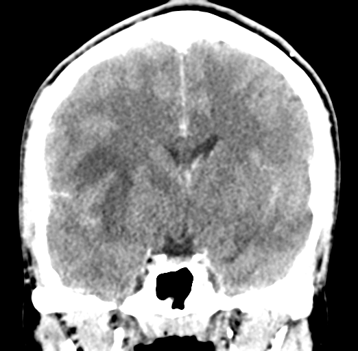 Cerebral abscess (Radiopaedia 60342-68008 Coronal C+ delayed 32).png