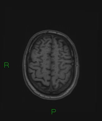 Cerebral abscess and subdural empyema (Radiopaedia 84436-99779 Axial T1 21).jpg