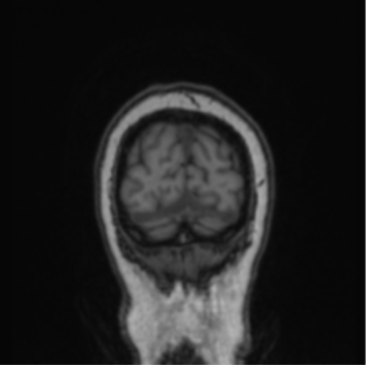 File:Cerebral abscess from pulmonary arteriovenous malformation (Radiopaedia 86275-102291 Coronal T1 12).png