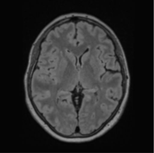 File:Cerebral abscess from pulmonary arteriovenous malformation (Radiopaedia 86275-102291 J 39).png