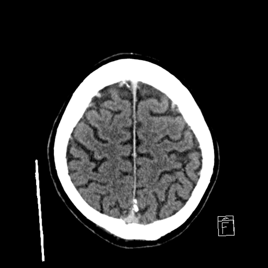 File:Cerebral abscess with ventriculitis (Radiopaedia 78965-91877 A 39).jpg
