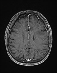 Cerebral amyloid angiopathy-related inflammation (Radiopaedia 58270-65377 Axial T1 C+ fat sat 99).jpg