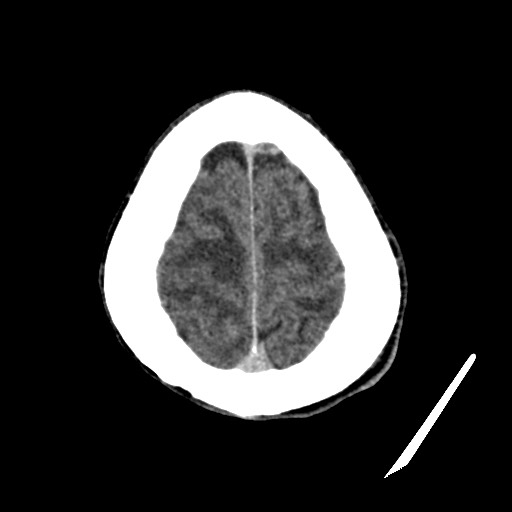 File:Cerebral amyloid angiopathy-related inflammation (Radiopaedia 74836-85848 Axial non-contrast 53).jpg