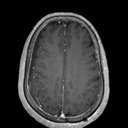 Cerebral amyloid angiopathy (Radiopaedia 29129-29518 Axial T1 C+ 102).jpg