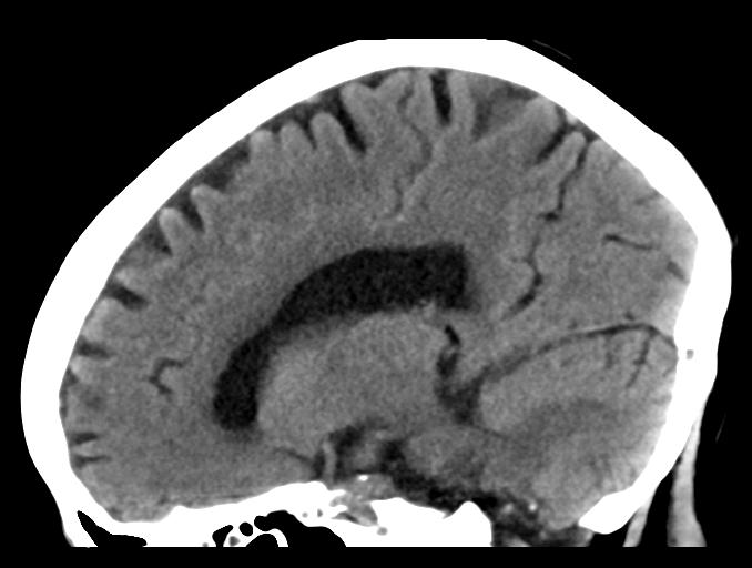 File:Cerebral aneurysm with rupture (Radiopaedia 29933-30457 B 18).jpg