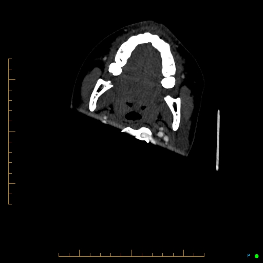 Cerebral arteriovenous malformation (AVM) (Radiopaedia 78162-90706 Axial CTA 7).jpg