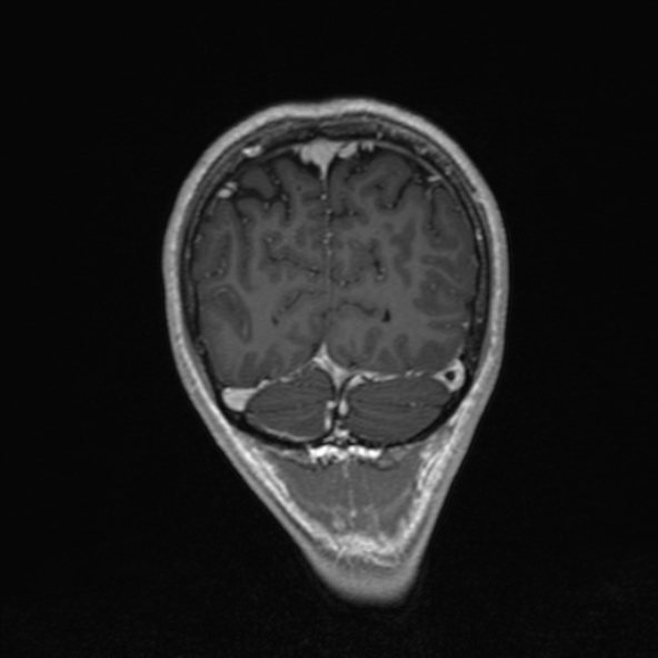 Cerebral arteriovenous malformation (Radiopaedia 30198-30813 F 49).jpg