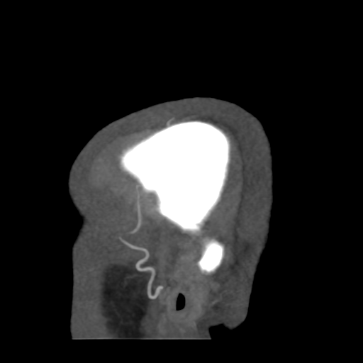 Cerebral arteriovenous malformation (Radiopaedia 39259-41505 Sagittal 4).png