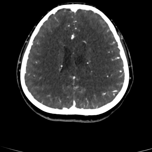 Cerebral arteriovenous malformation (Radiopaedia 73830-84645 Axial C+ delayed 32).jpg