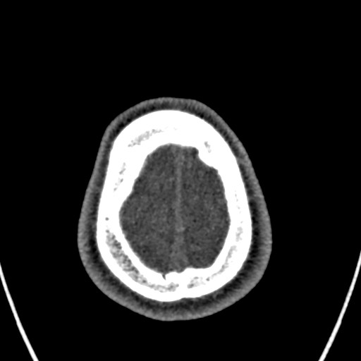 Cerebral arteriovenous malformation (Radiopaedia 78188-90746 Axial non-contrast 166).jpg