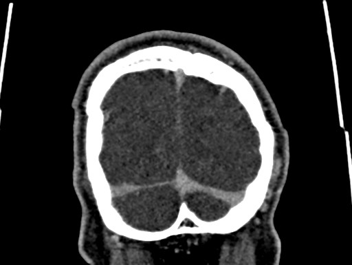 Cerebral arteriovenous malformation (Radiopaedia 78188-90746 Coronal C+ delayed 116).jpg