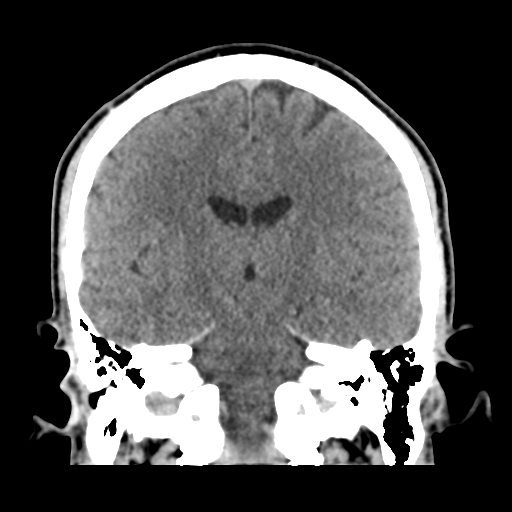 Cerebral arteriovenous malformation (Spetzler-Martin grade 2) (Radiopaedia 41262-44076 Coronal non-contrast 34).png