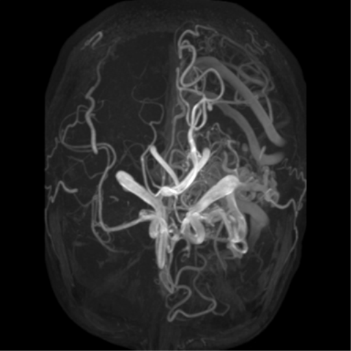 File:Cerebral arteriovenous malformation - huge (Radiopaedia 35734-37272 MRA 15).png