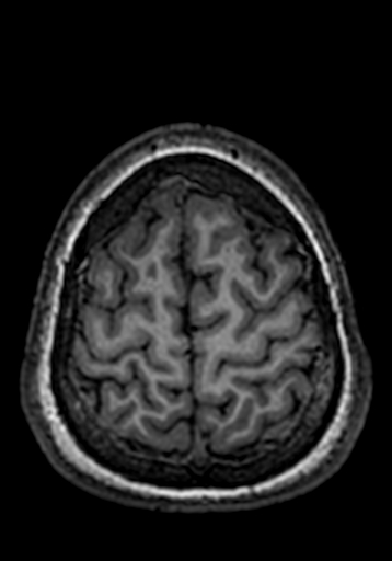 Cerebral arteriovenous malformation at posterior body of corpus callosum (Radiopaedia 74111-84925 Axial T1 30).jpg