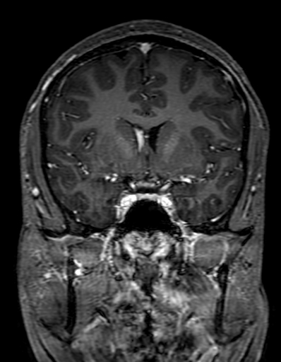 Cerebral arteriovenous malformation at posterior body of corpus callosum (Radiopaedia 74111-84925 K 143).jpg