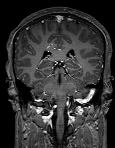Cerebral arteriovenous malformation at posterior body of corpus callosum (Radiopaedia 74111-84925 K 235).jpg