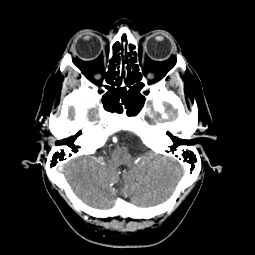 Cerebral arteriovenous malformation with lobar hemorrhage (Radiopaedia 35598-57216 A 12).jpg