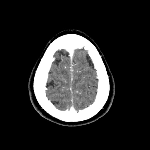 Cerebral arteriovenous malformation with lobar hemorrhage (Radiopaedia 35598-57216 A 55).jpg