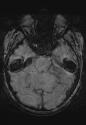 File:Cerebral cavernoma and development venous anomaly (Radiopaedia 37603-39482 Axial SWI 13).png