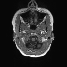 Cerebral cavernous venous malformation (Radiopaedia 70008-80021 Axial T1 2).jpg