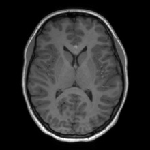 Cerebral cavernous venous malformation (Radiopaedia 70008-80021 Axial T1 41).jpg