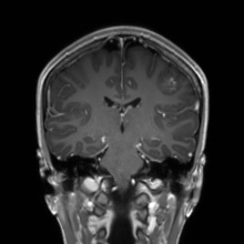 Cerebral cavernous venous malformation (Radiopaedia 70008-80021 Coronal T1 C+ 28).jpg