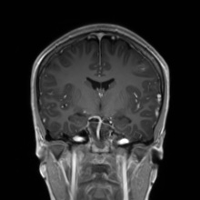 Cerebral cavernous venous malformation (Radiopaedia 70008-80021 Coronal T1 C+ 33).jpg