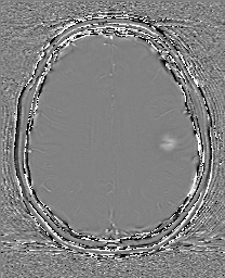 Cerebral cavernous venous malformation (Radiopaedia 70008-80021 G 50).jpg